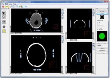 Stereotactic Localization